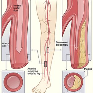 peripheral artery disease