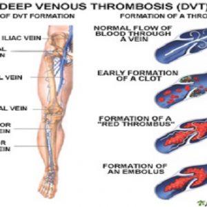 Varicose vein trea