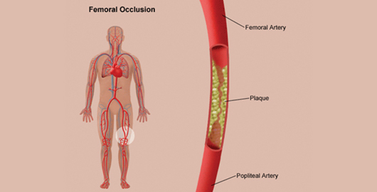 Vascular Surgery in Pune