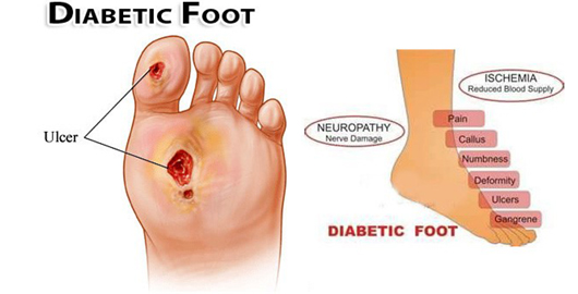 Diabetic foot care