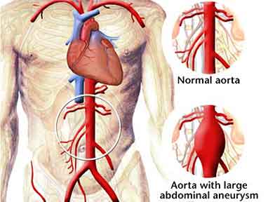 Surgery for Aortic Aneurysms
