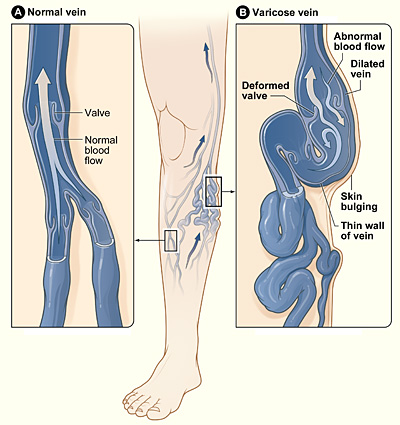 surgery-for-varicose-veins