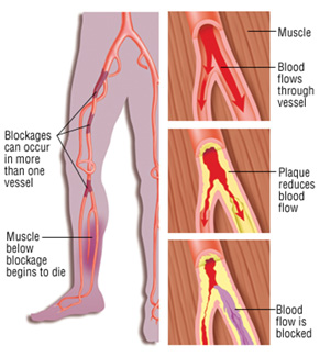 Peripheral Artery Disease -vascular surgeon