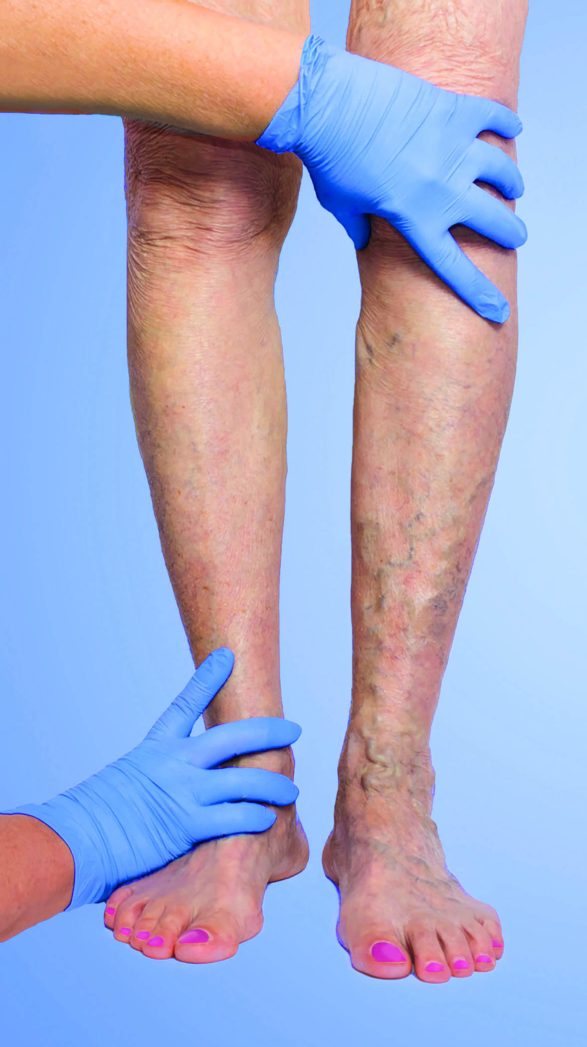 Varicose Veins Treatment in Pune :: Dr. Advait Kothurkar