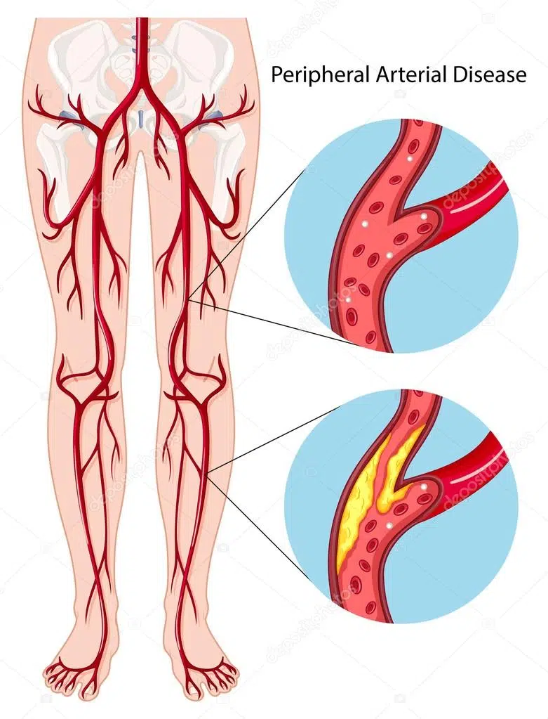 depositphotos_115173936-stock-illustration-peripheral-arterial-disease-diagram